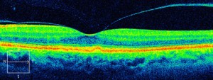 Dry ARMD OCT scan @ Mark Hinds Optometrists, specialty contact lenses, keratoconus, scleral contact lenses, orthoK Brisbane, children’s optometrist, contact lens specialist, synergeyes contact lenses, keratoconus contact lenses, orthokeratology, hard contact lenses, maui jim, RGP contact lenses, corneal specialist, optometrist Brisbane, myopia control – phone 07 3358 6566 / orders@markhindsoptometrists.com.au ; voted Brisbane’s best optometrist