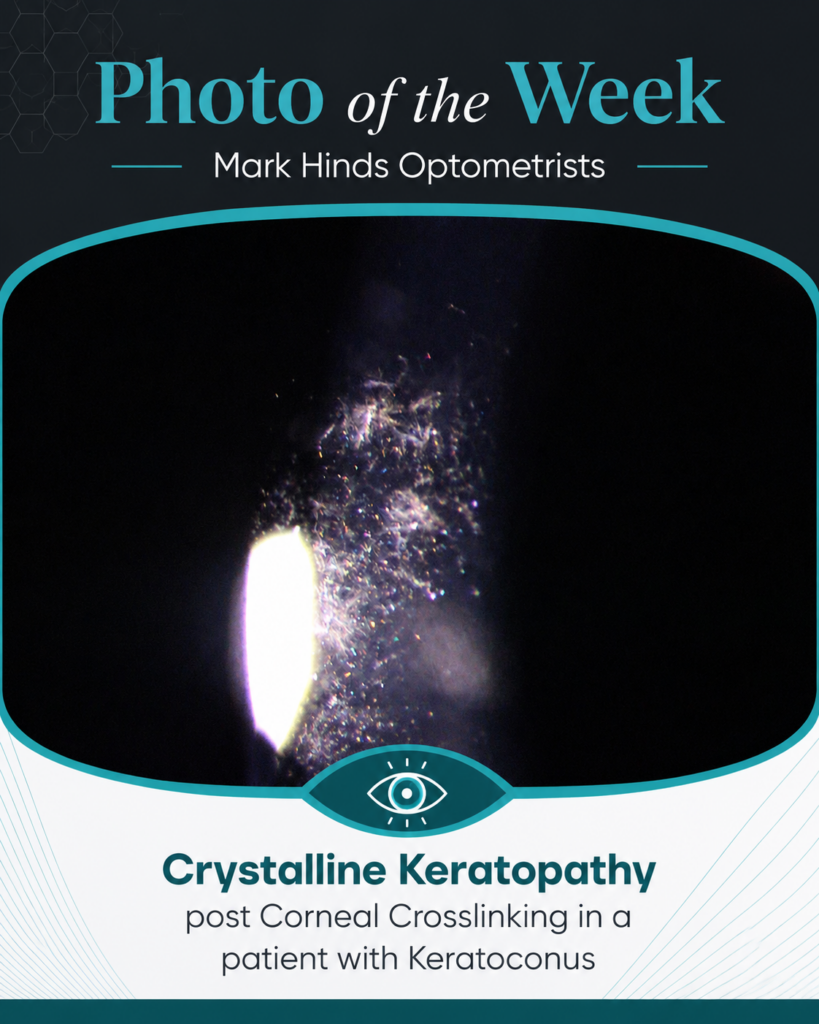 BLOG CRYSTALLINE KERATOPATHY CXL